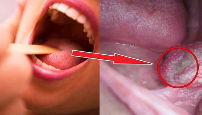 Căn bệnh ung thư vòm họng đe doạ người Việt: 3 dấu hiệu điển hình nhận biết ung thư sớm - Ảnh 1.
