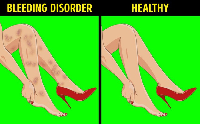 6 dấu hiệu bất thường ở chân cảnh báo bệnh nguy hiểm - Ảnh 5.