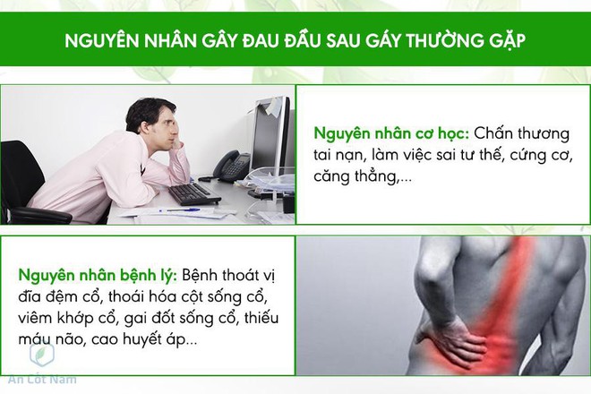 Điều trị đau đầu sau gáy do bệnh lý cột sống hiệu quả bằng cách nào? - Ảnh 1.