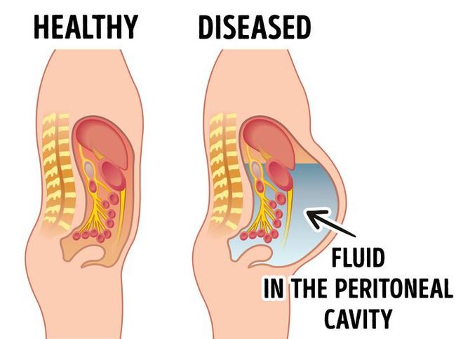 8 dấu hiệu cảnh báo bệnh gan: Nếu có triệu chứng là bạn cần đến bác sĩ càng sớm càng tốt - Ảnh 3.