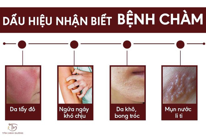 Bệnh chàm là gì? Nguyên nhân, triệu chứng và cách chữa hiệu nghiệm - Ảnh 2.