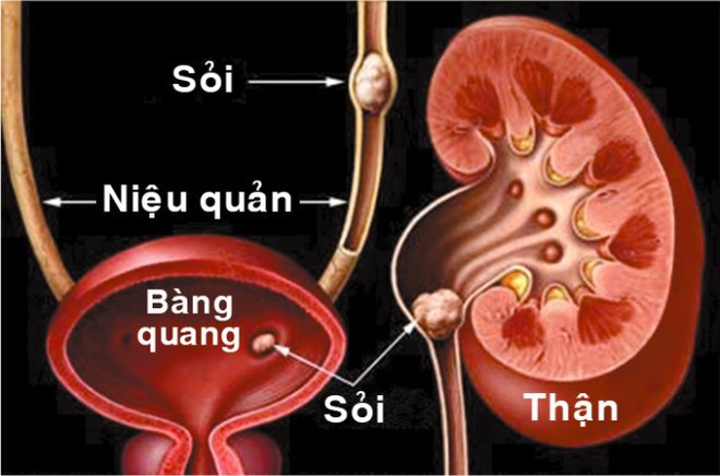 Phòng trị sỏi tiết niệu bằng rau, củ - Ảnh 1.