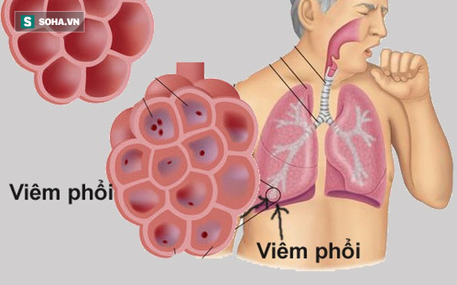 4 loại thực phẩm vàng tốt nhất cho phổi: Người có bệnh thì nên ăn nhiều để giảm viêm - Ảnh 1.