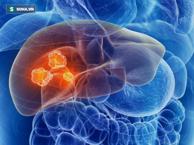 Cẩn thận với các khối u phát triển âm thầm trong gan: Đây là 4 tín hiệu sớm nhất cần biết - Ảnh 1.