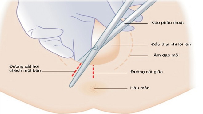 Đẻ thường phải rạch tầng sinh môn