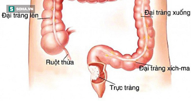 5 việc làm để ngăn chặn nguy cơ mắc ung thư trực tràng: Đừng để mầm bệnh lớn rồi mới biết - Ảnh 1.