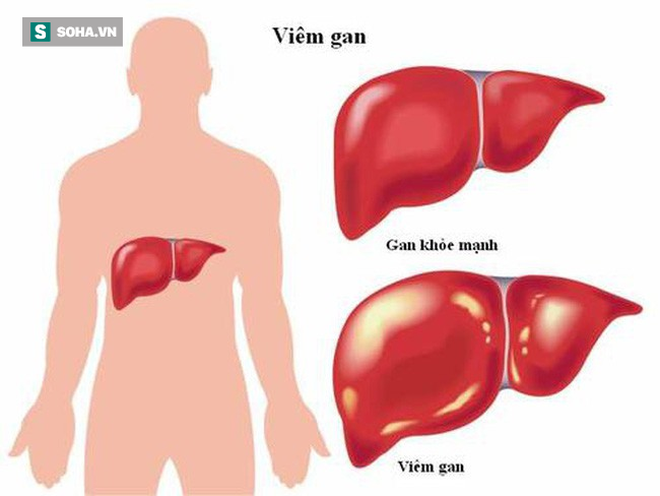 5 triệu chứng sớm của bệnh viêm gan và gợi ý phương thuốc tự nhiên giúp phục gan - Ảnh 1.