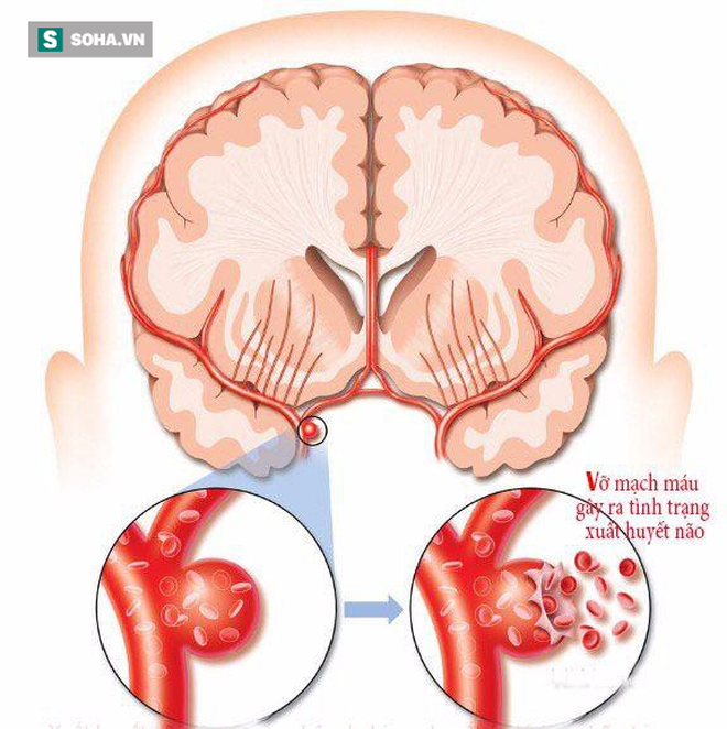 Chơi game và dùng điện thoại lâu gây chảy máu não đột ngột: Đừng để bi kịch xảy ra với bạn - Ảnh 1.
