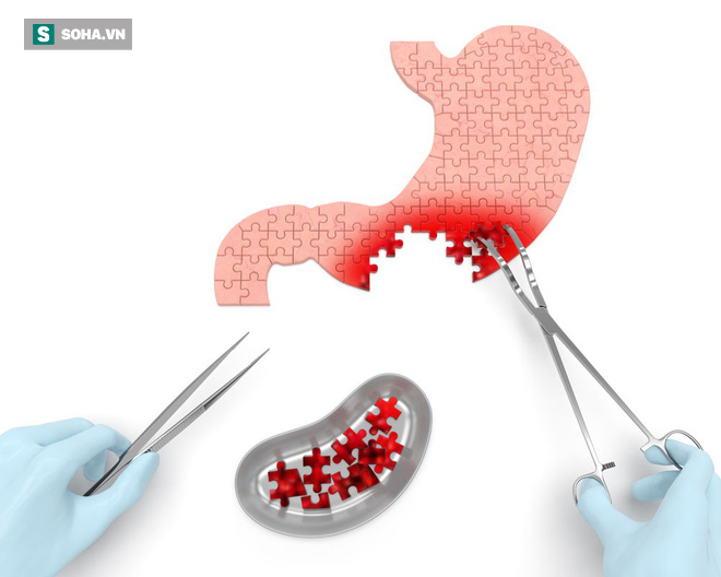 Nếu có 1 trong 4 dấu hiệu sớm nhất của bệnh ung thư dạ dày, tuyệt đối không nên xem nhẹ - Ảnh 1.