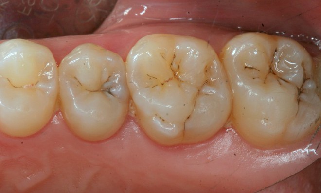 Chuyện gì sẽ xảy ra nếu có một lỗ hổng trên bề mặt răng mà bạn không điều trị ngay? - Ảnh 3.