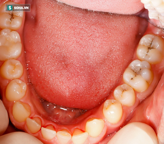 Chuyện gì sẽ xảy ra nếu có một lỗ hổng trên bề mặt răng mà bạn không điều trị ngay? - Ảnh 1.