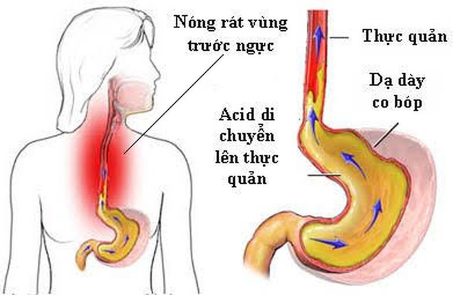 Trào ngược thực quản có thể biến chứng thành ung thư: GS tiêu hoá mách cách sống chung - Ảnh 2.