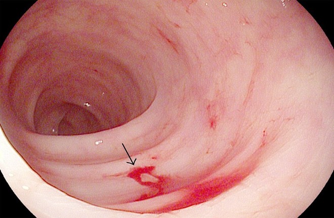 5 dấu hiệu của bệnh viêm trực tràng: Không điều trị sẽ có nguy cơ tiến triển thành ung thư - Ảnh 3.
