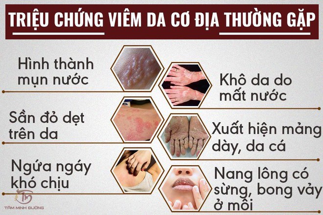 Cách trị viêm da cơ địa dị ứng hay gặp ở người lớn - Ảnh 2.