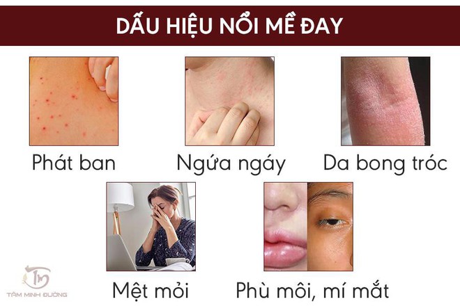 Nổi mề đay ngứa khắp người kiêng gì để hết ngứa, khỏi bệnh nhanh? - Ảnh 2.