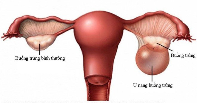 Lạm dụng thuốc tránh thai khẩn cấp: Nhiều tác hại khôn lường, thậm chí có thể gây ung thư - Ảnh 4.