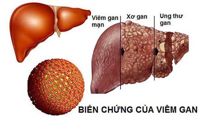 Bệnh gan rất nguy hiểm vì gây tử vong sớm: Chuyên gia ung thư gan chỉ cách phòng ngừa đúng - Ảnh 1.