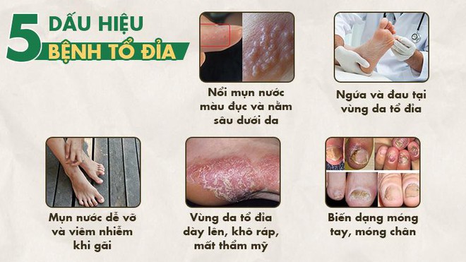 Bệnh eczema tổ đỉa là gì? Dấu hiệu và cách chữa bằng thảo dược lành tính - Ảnh 1.