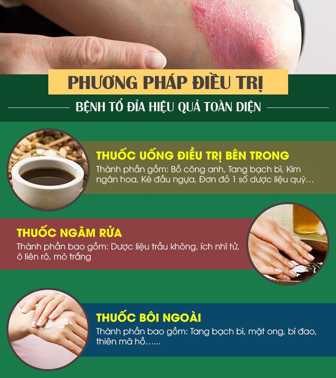 Bệnh eczema tổ đỉa là gì? Dấu hiệu và cách chữa bằng thảo dược lành tính - Ảnh 2.