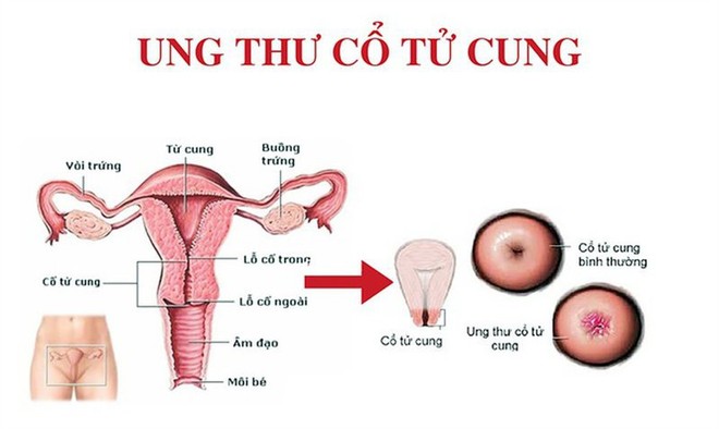 4 nhóm người có nguy cơ ung thư cao: BS khuyên khám ngay, chần chừ 1 năm cũng nguy hiểm - Ảnh 5.