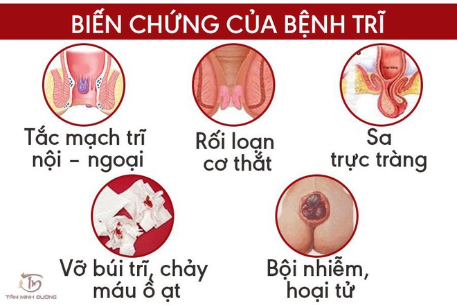 Trĩ nội - Trĩ ngoại: Nguyên nhân, dấu hiệu và cách chữa bệnh dễ dàng - Ảnh 2.