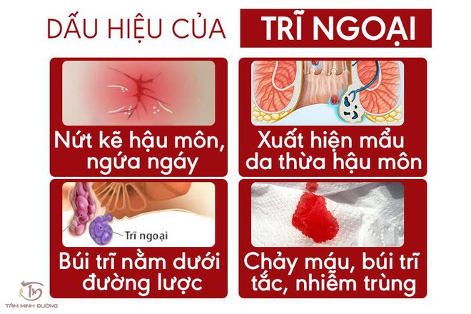 Trĩ nội - Trĩ ngoại: Nguyên nhân, dấu hiệu và cách chữa bệnh dễ dàng - Ảnh 3.