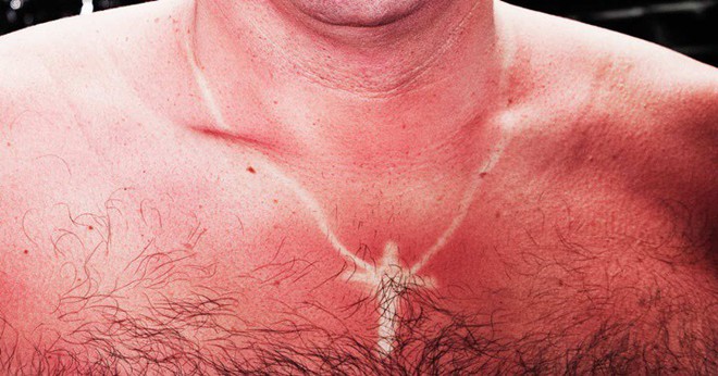 Điều gì làm cho làn da của bạn đỏ sau khi bị cháy nắng? - Ảnh 1.