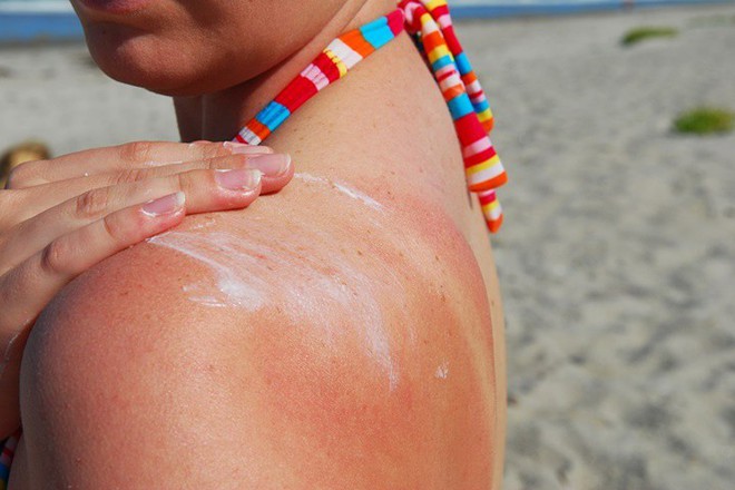 Điều gì làm cho làn da của bạn đỏ sau khi bị cháy nắng? - Ảnh 4.