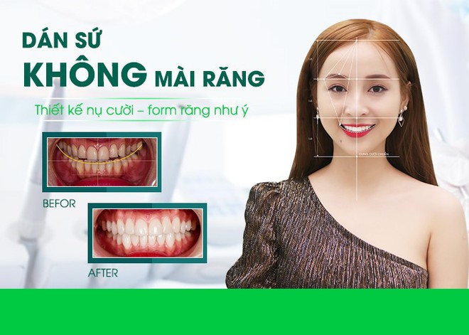 Giải pháp cho hàm răng sậm màu, nhiễm Tetra - Ảnh 2.