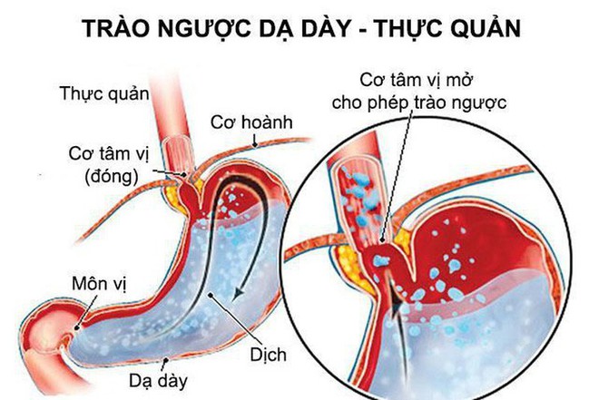 Phương thức hay chữa trào ngược dạ dày - thực quản - Ảnh 1.