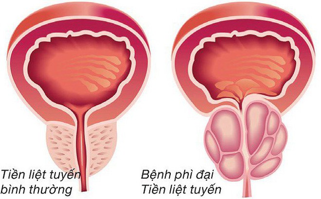 Bị phì đại tuyến tiền liệt chữa như vậy nào?