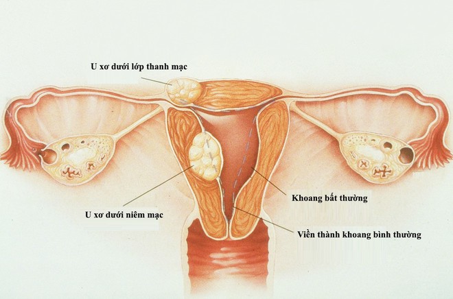 Một số bệnh phụ khoa gây vô sinh - Ảnh 1.