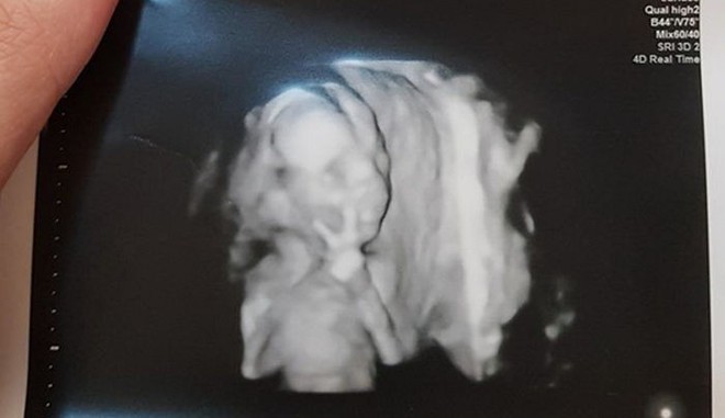 Chụp ảnh siêu âm mà giơ tay chào đủ kiểu, em bé từ trong bụng mẹ ...