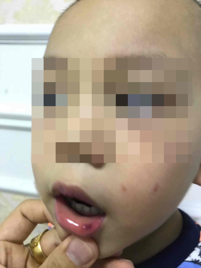 Cô giáo ở Hà Nội tát bé hơn 2 tuổi sấp mặt, tụ máu môi đang bị hoảng loạn và có suy nghĩ quẩn - Ảnh 1.