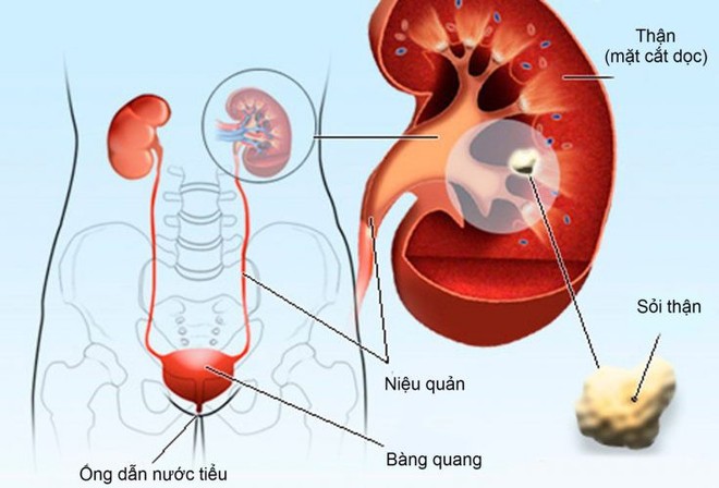 Sỏi thận, tiết niệu: nhỏ hay to đều không lo phẫu thuật với công nghệ mới nhất hiện nay - Ảnh 1.