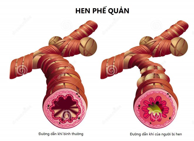 Bài thuốc chữa viêm phế quản mạn tính - Ảnh 1.