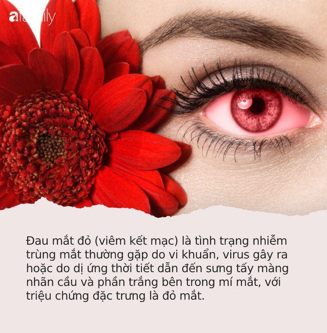 Đau mắt đỏ: Căn bệnh dễ lây mạnh, cần cảnh giác cao trong mùa hè này - Ảnh 1.