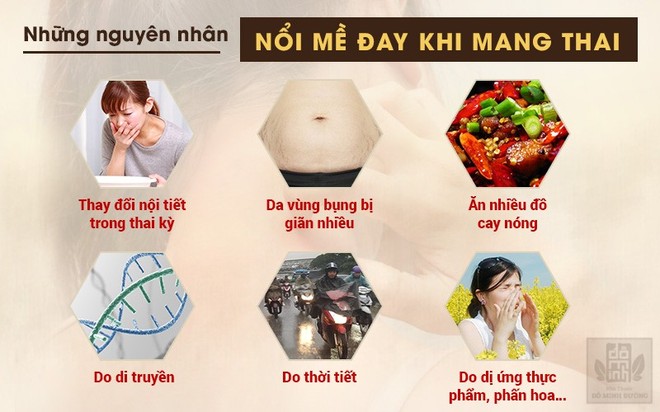 Nổi mề đay khi mang thai – dấu hiệu và cách chữa an toàn cho mẹ bầu - Ảnh 1.