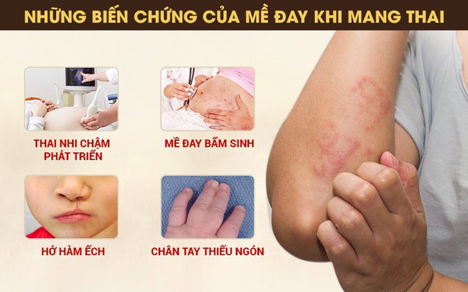 Nổi mề đay khi mang thai – dấu hiệu và cách chữa an toàn cho mẹ bầu - Ảnh 2.