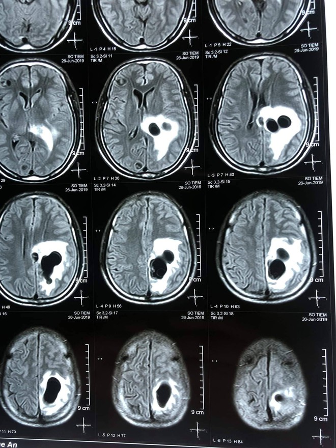 Đau đầu đi cấp cứu phát hiện 5 ổ sán lớn nằm trong não người đàn ông ăn tiết canh - Ảnh 1.
