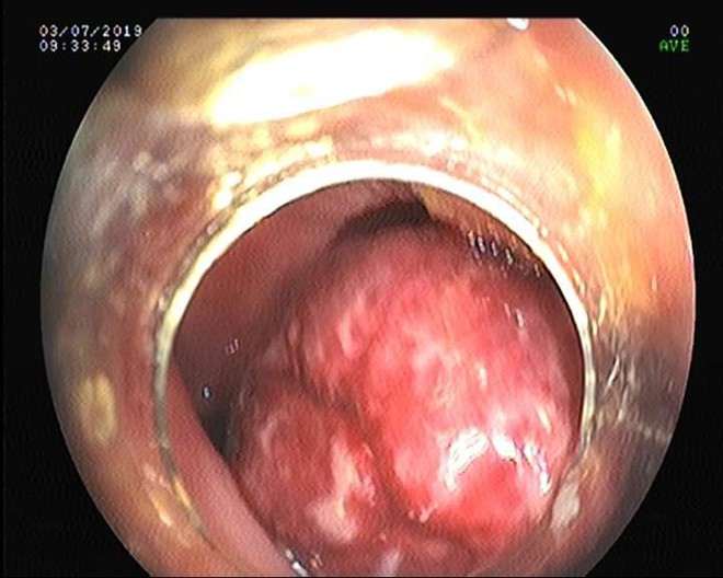 Nhiều trẻ bị polyp đại trực tràng đi ngoài ra máu, cha mẹ lầm tưởng con bị táo bón - Ảnh 1.