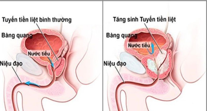 Tiểu nhiều lần trong ngày ở nam giới là bệnh gì? - Ảnh 2.