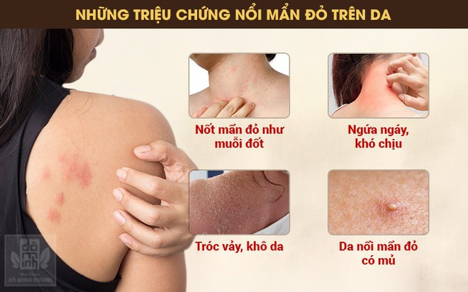 Nổi mẩn đỏ ngứa da là bệnh gì? Nguyên nhân, triệu chứng và cách chữa hiệu quả - Ảnh 1.