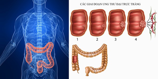 Khi đại trực tràng gửi đến bạn 5 tín hiệu này: Hãy cẩn thận đi kiểm tra ung thư ngay - Ảnh 1.