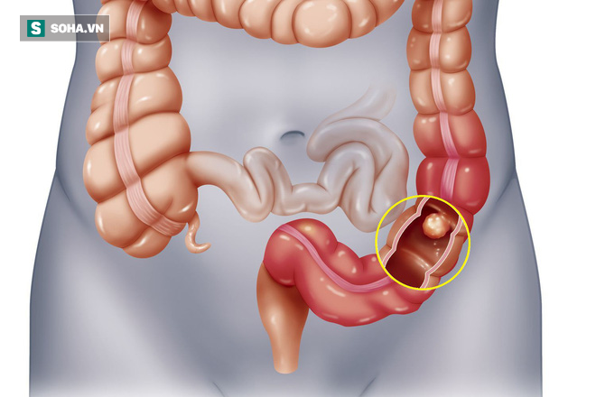 Khi đại trực tràng gửi đến bạn 5 tín hiệu này: Hãy cẩn thận đi kiểm tra ung thư ngay - Ảnh 2.