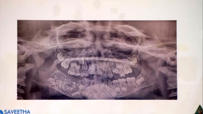 Bé trai 7 tuổi kêu đau hàm, bác sĩ “choáng” khi nhổ hơn 500 chiếc răng trong khoang miệng - Ảnh 2.
