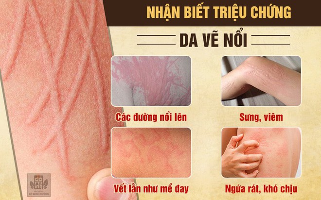 Dị ứng da vẽ nổi: Nguyên nhân, triệu chứng và cách chữa an toàn từ ...