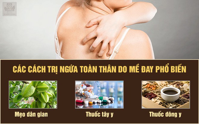 Ngứa toàn thân do mề đay: Nguyên nhân, triệu chứng và cách chữa trị  - Ảnh 2.