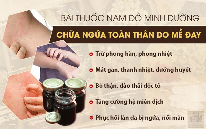 Ngứa toàn thân do mề đay: Nguyên nhân, triệu chứng và cách chữa trị  - Ảnh 3.