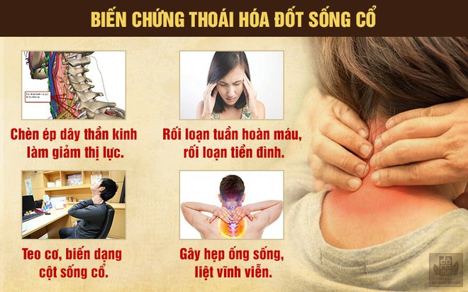 Thoái hóa đốt sống cổ là gì? Nguyên nhân, triệu chứng và cách chữa hiệu quả - Ảnh 2.